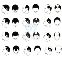 【佳學(xué)基因檢測】過早<font color='red'>脫發(fā)</font>、掉發(fā)太多怎么辦？你的方法可能是錯的！