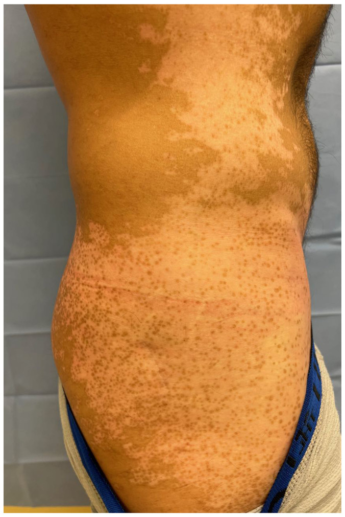 白癜風(fēng)大面積毛囊周圍色素沉著